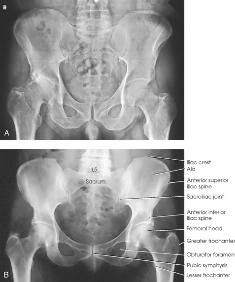 AP Pelvic X-ray with Labeled Radiologic Landmarks