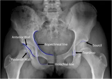 Annotated AP pelvis X-ray: Iliopectineal & Ilioischial lines
