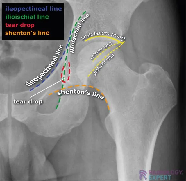Pelvic Radiologic Landmarks on AP Hip X-ray