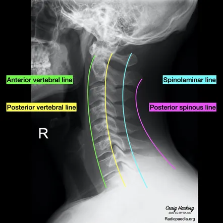 Lateral C-Spine X-ray with Alignment Lines