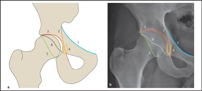 Pelvic Radiograph: Pediatric Skeletal Landmarks
