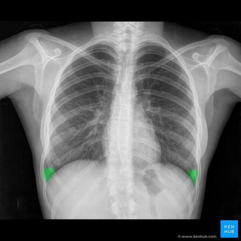 Chest X-ray PA view: Costophrenic angles highlighted