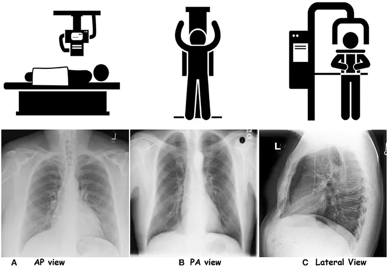 Chest X-ray views: AP, PA, and Lateral