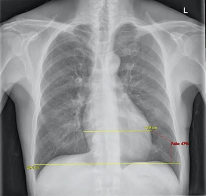 PA Chest X-ray: Cardiothoracic Ratio Measurement