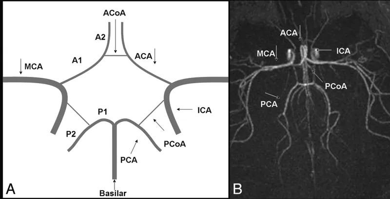 Circle of Willis: Diagram vs. MRA