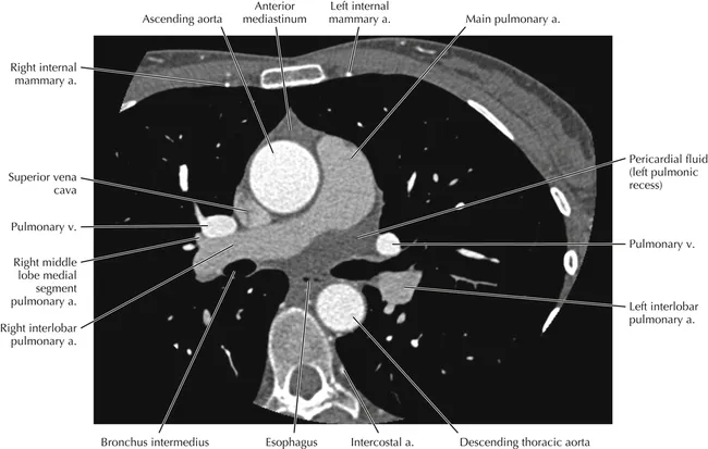 Axial CT chest: Labeled great vessels and mediastinum