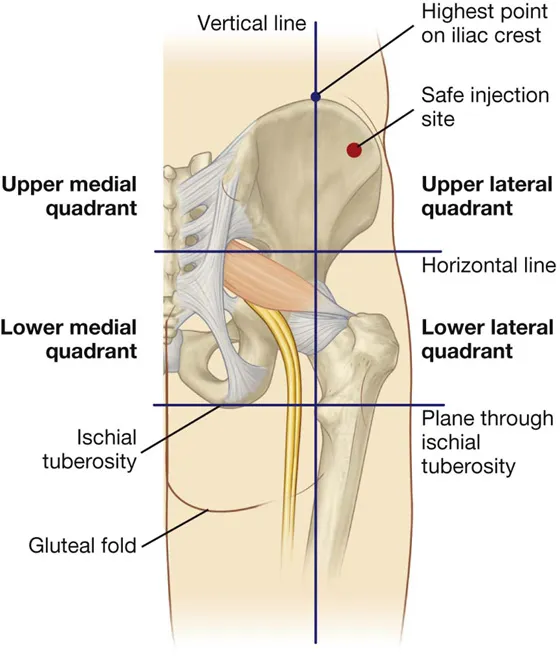 Gluteal region surface landmarks and safe injection site