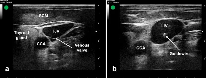 Ultrasound of IJV cannulation with guidewire
