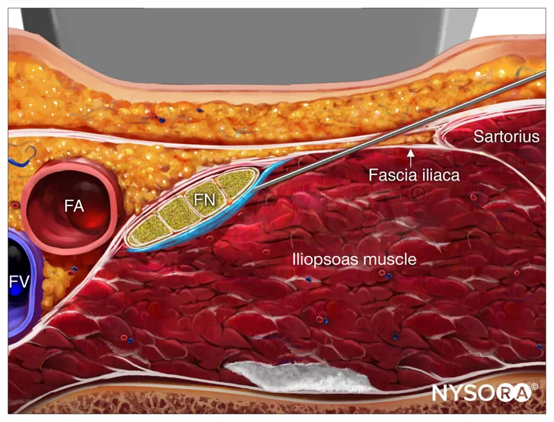 Ultrasound-guided femoral nerve block