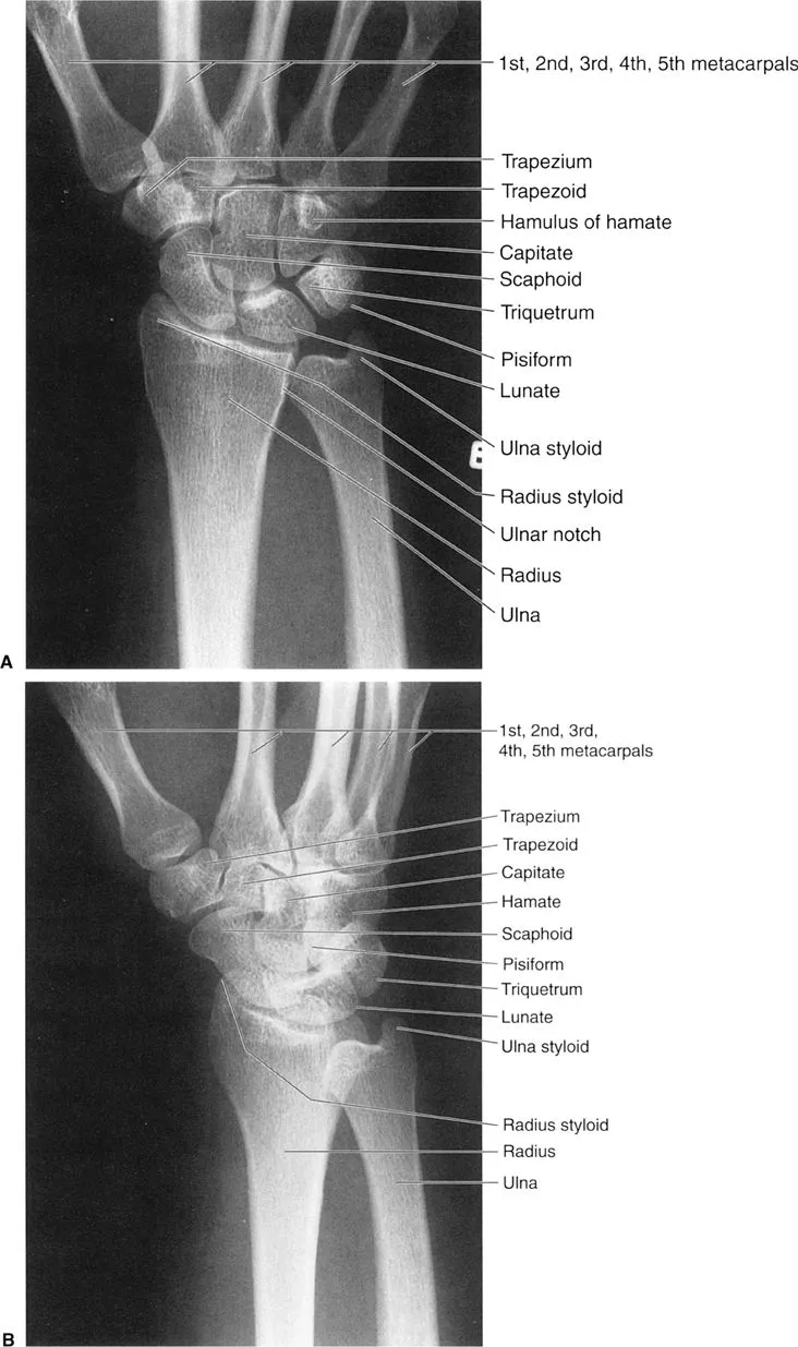 Wrist X-ray with anatomical labels
