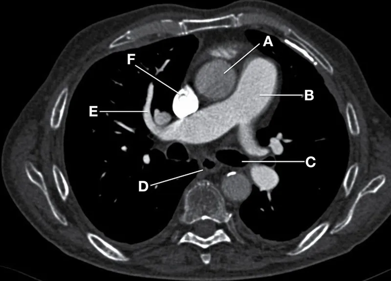 Axial CT chest with key structures labeled