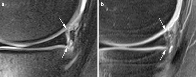 Knee MRI: Meniscal tear and ACL injury