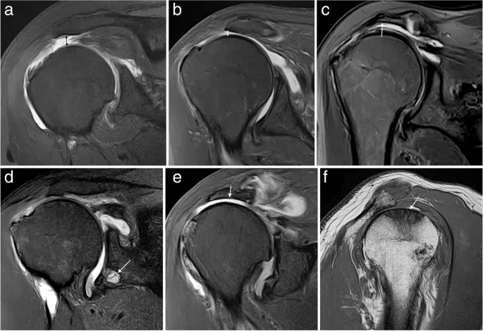 Axial T2 Shoulder MRI: Rotator Cuff Tears