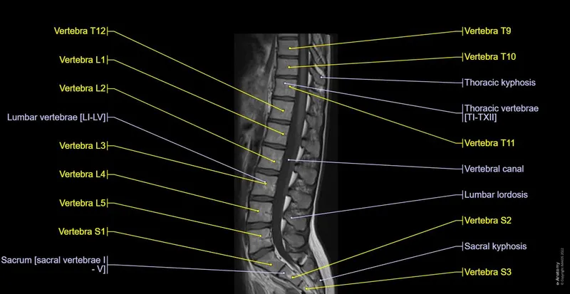 Spine MRI sagittal T2 with vertebral and curvature labels