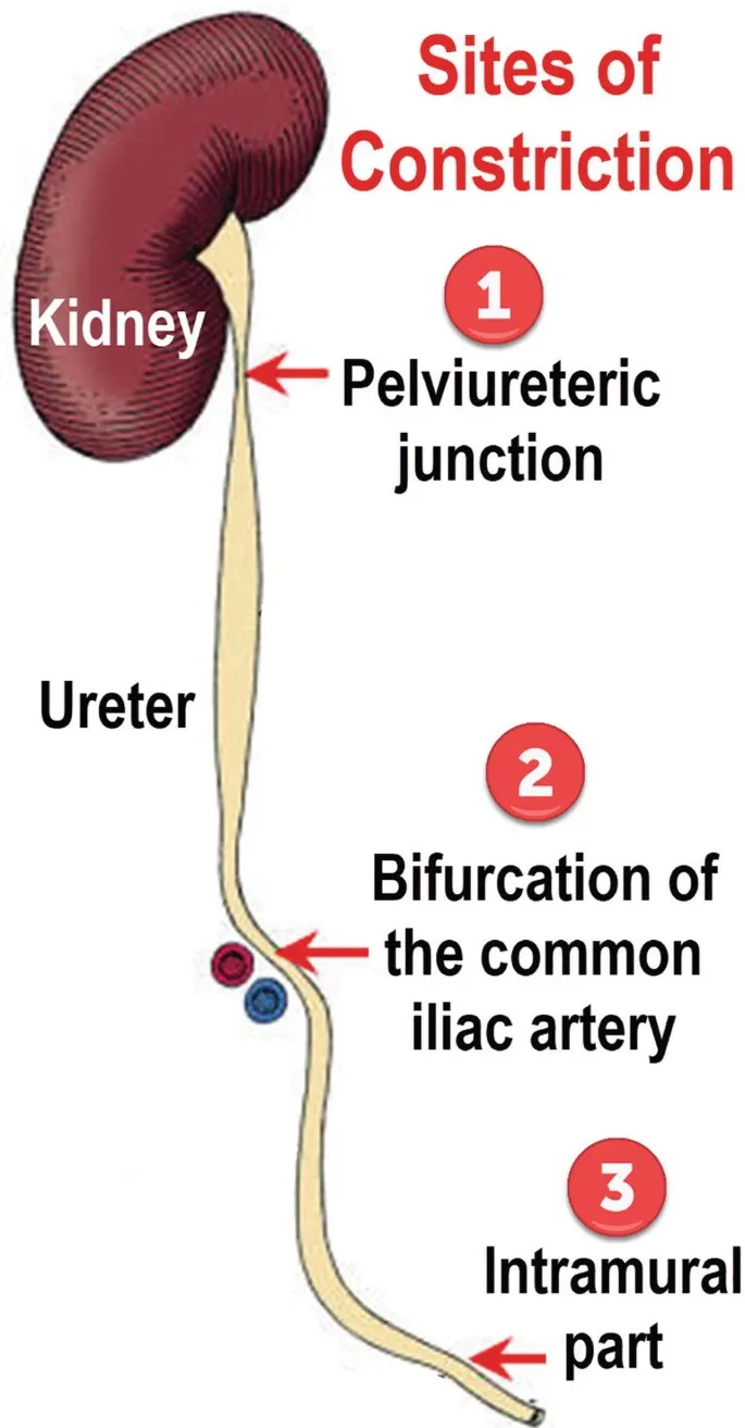 Sites of ureteric constriction