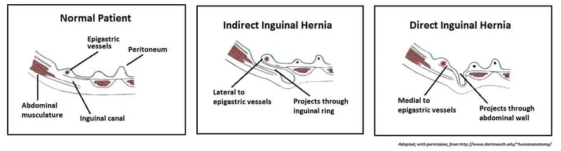 Inguinal Canal: Normal vs. Indirect & Direct Hernias
