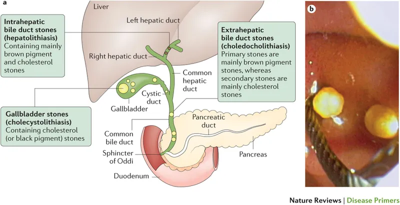 Biliary tree anatomy & gallstone obstruction sites