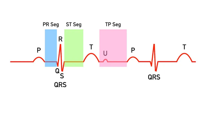 ECG waveform with labeled P, QRS, T waves and segments