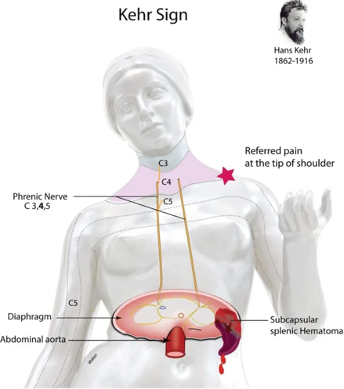 Kehr’s Sign: Referred Pain from Subcapsular Splenic Hematoma