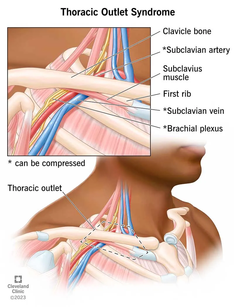 Thoracic Outlet Syndrome Anatomy and Compression Sites