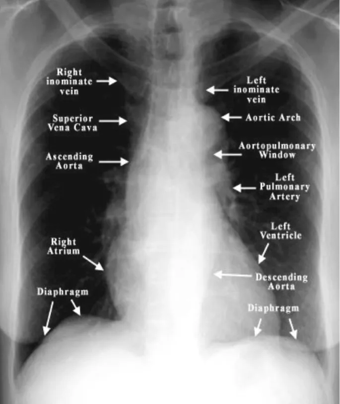 Annotated PA Chest X-ray: Mediastinal Anatomy