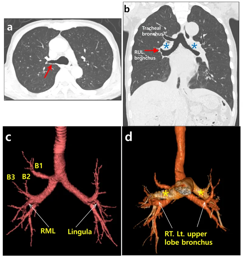 CT and 3D reconstruction of bronchial anatomy