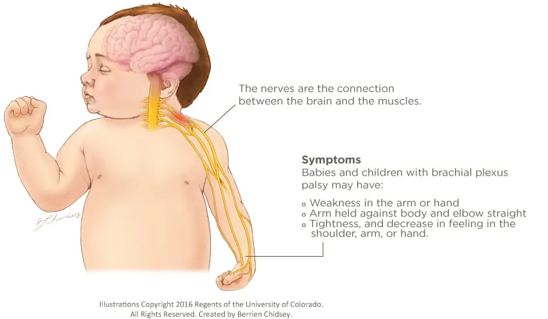 Symptoms of Brachial Plexus Palsy in Infants