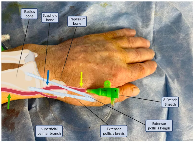 Wrist anatomy with radial artery access