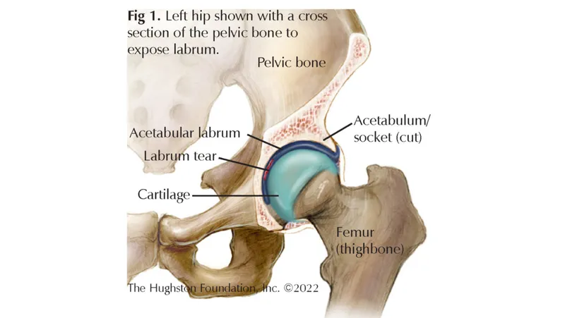 Hip Joint Anatomy with Labrum Tear