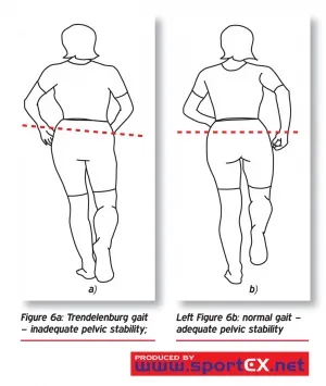 Trendelenburg vs. Normal Gait: Pelvic Stability