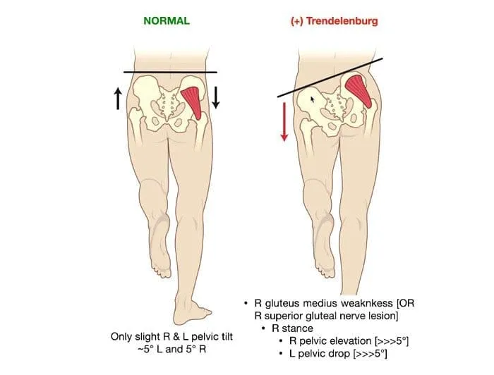 Normal vs. Trendelenburg Gait