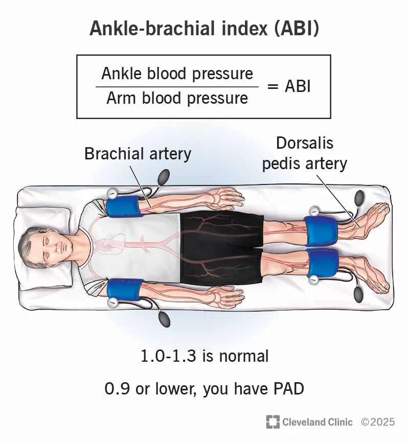 Ankle-Brachial Index (ABI) Measurement and Interpretation