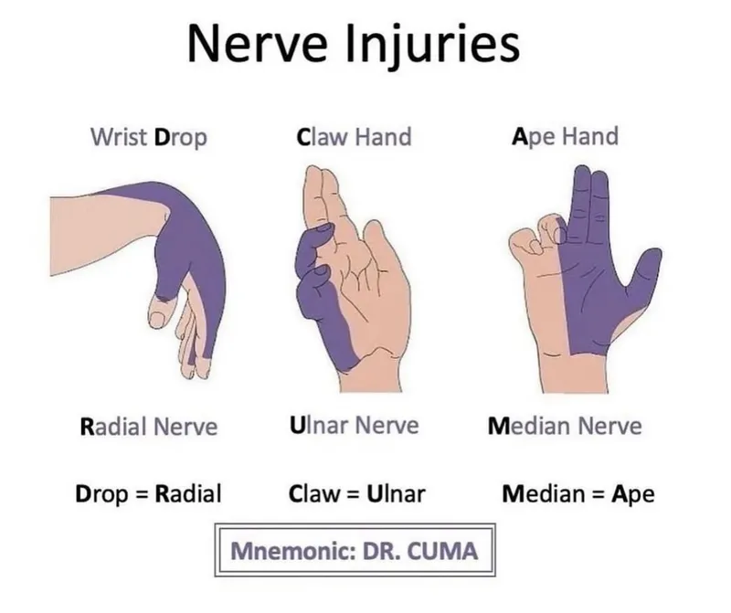 Nerve Injuries: Wrist Drop, Claw Hand, Ape Hand