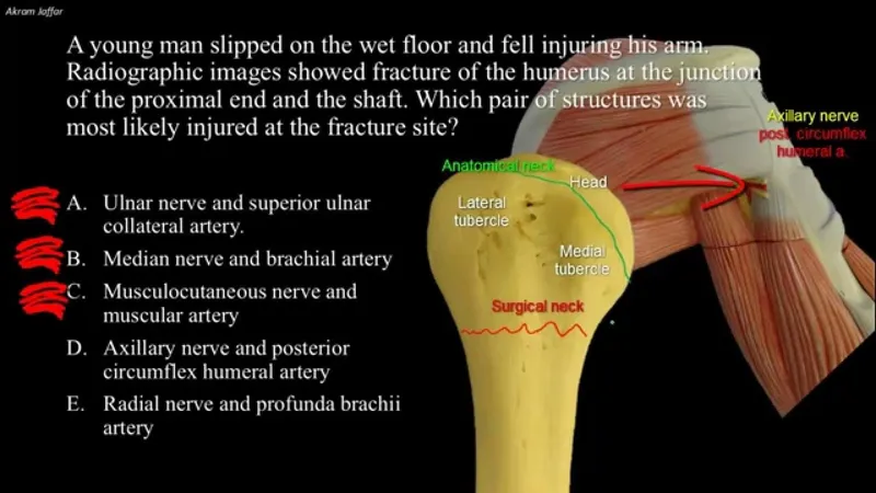 Humerus fracture & associated nerve/artery injury