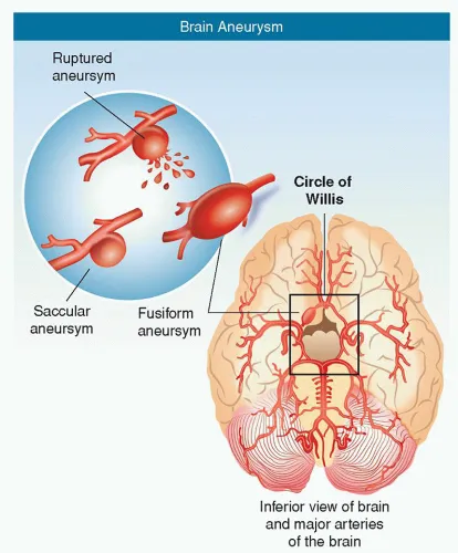 Brain Aneurysm and Circle of Willis