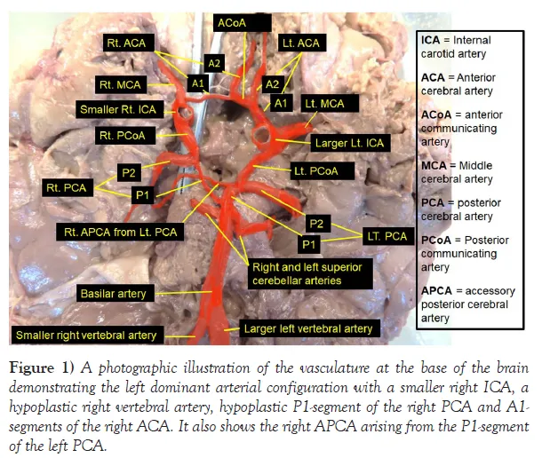 Circle of Willis variations: hypoplastic vessels, APCA