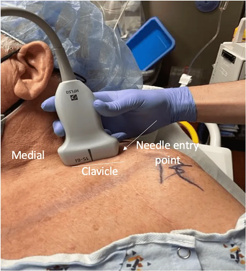 Ultrasound-guided supraclavicular brachial plexus block
