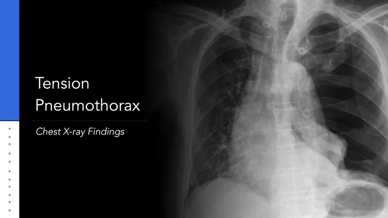 Chest X-ray showing tension pneumothorax