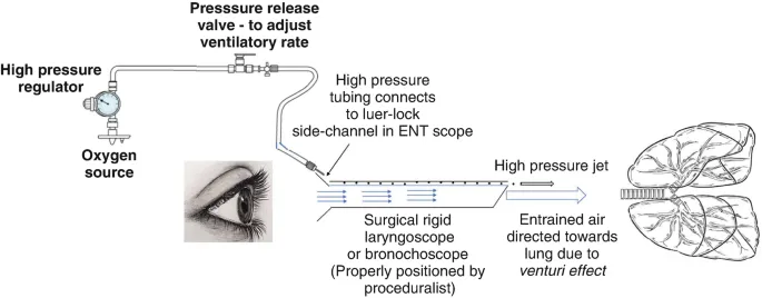 Jet ventilation setup for bronchoscopy