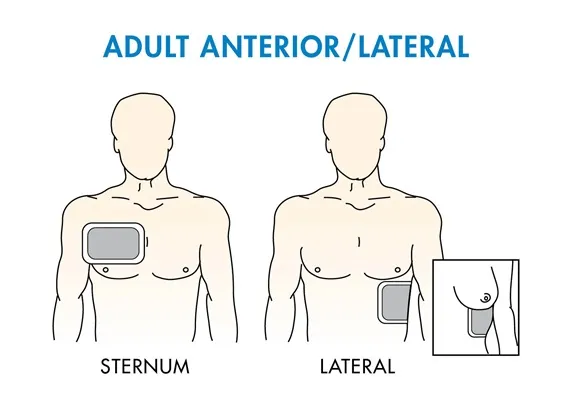 Adult anterior/lateral defibrillator pad placement