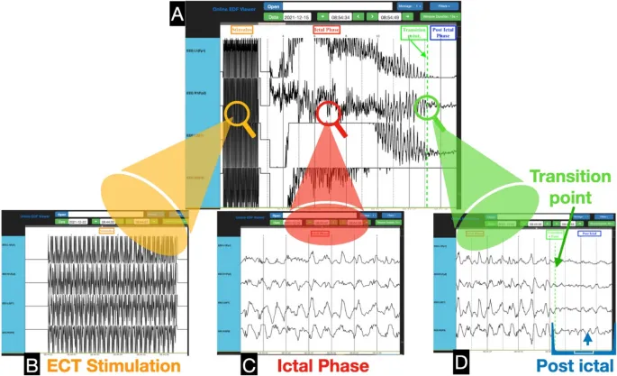 EEG waveform during ECT seizure phases
