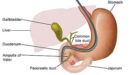 ERCP procedure anatomy