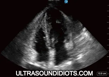 Ultrasound: Cardiac Tamponade with Pericardial Effusion