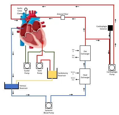 Cardiopulmonary bypass circuit diagram