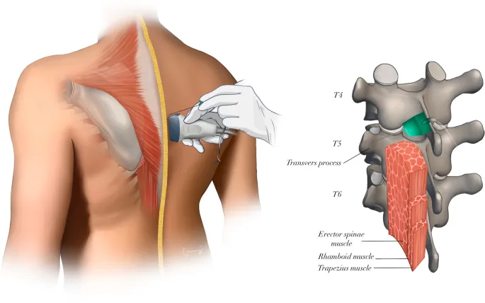 Erector Spinae Plane block for cardiac surgery analgesia