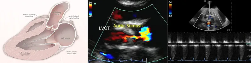 Echocardiogram and diagram of severe aortic stenosis