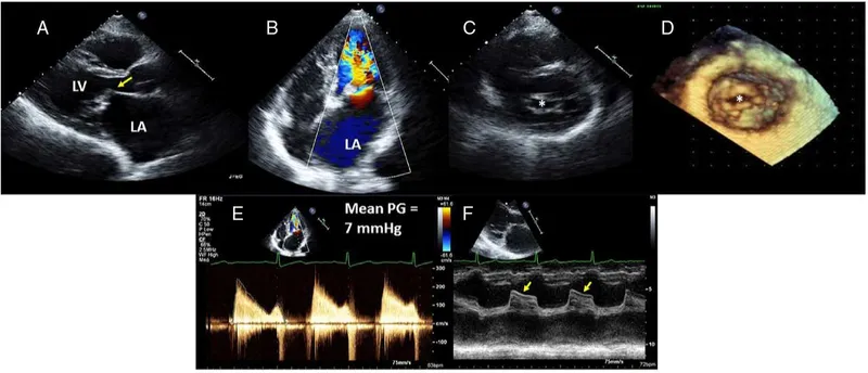 Echocardiogram views of mitral valve stenosis