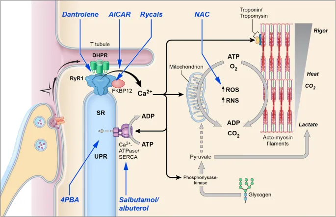Malignant Hyperthermia Pathophysiology