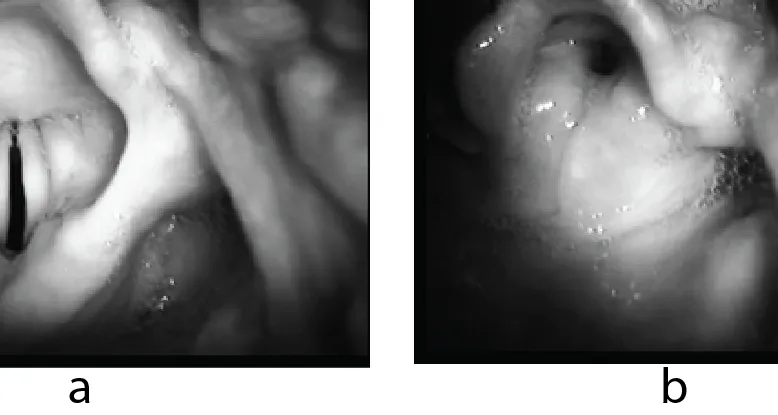 Larynx: Normal vs Laryngospasm