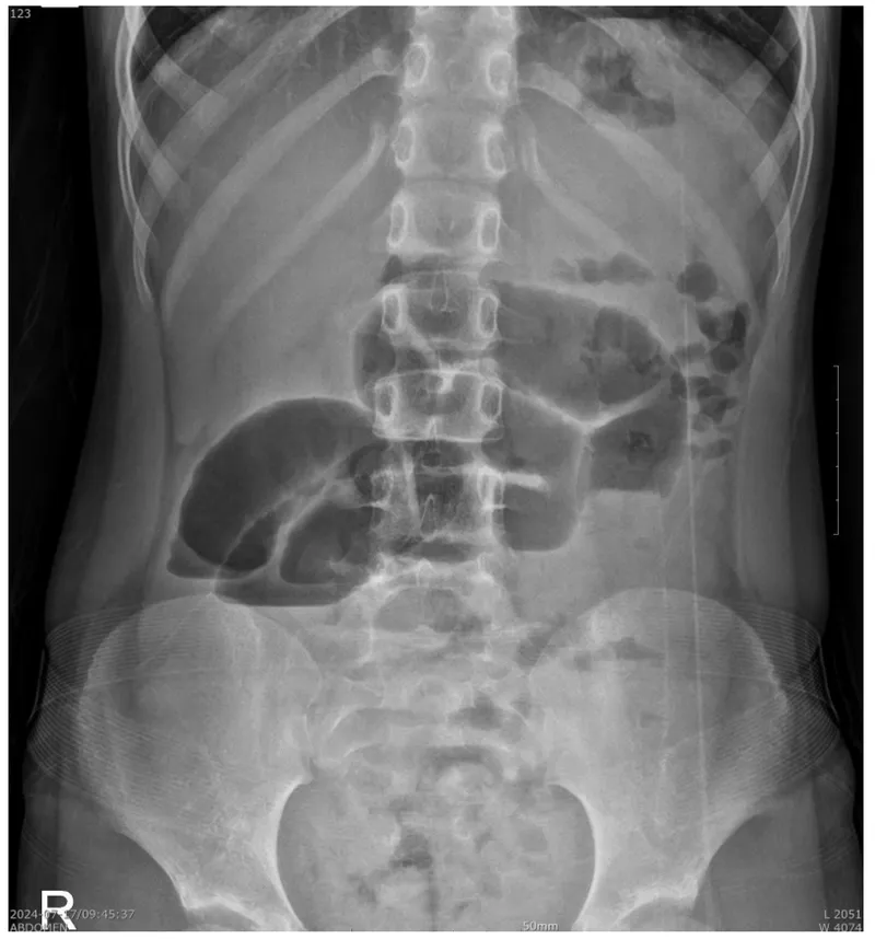 Abdominal X-ray: Dilated bowel loops in ileus